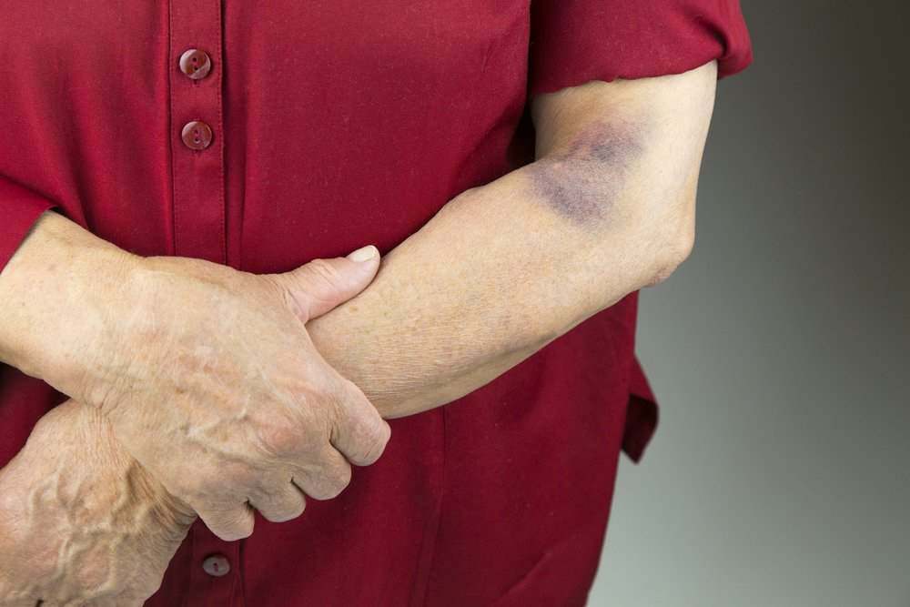 unexplained-bruising-in-the-elderly-and-how-to-prevent-it